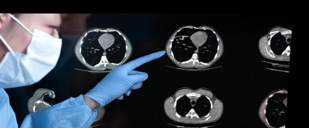 The image depicts a medical professional wearing blue gloves and a face mask, pointing with a gloved hand at a series of computed tomography (CT) scans of a human chest. The scans are displayed on a dark background, arranged in a 2x3 grid, showing cross-sectional views of the thoracic cavity, including the lungs, heart, and surrounding structures. The professional's hand is positioned over the central scan, highlighting a specific area, possibly indicating a region of interest such as a lesion or abnormality. The CT images are rendered in grayscale, with clear delineation of anatomical features, used for diagnostic purposes in a medical setting.