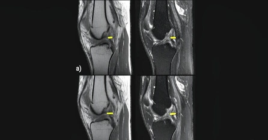 AI-Powered Bone Reconstruction a Medical Imaging Breakthrough