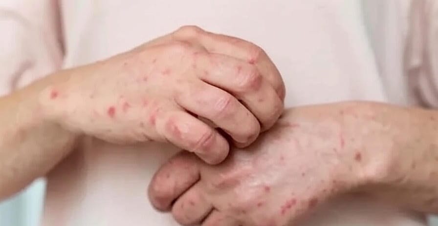 The image depicts a close-up view of a person's hands and forearms, showing visible red rashes and irritated skin. The individual is scratching one arm with the other hand, highlighting the discomfort caused by the skin condition. The background features a light-colored shirt, keeping the focus on the affected skin areas.
